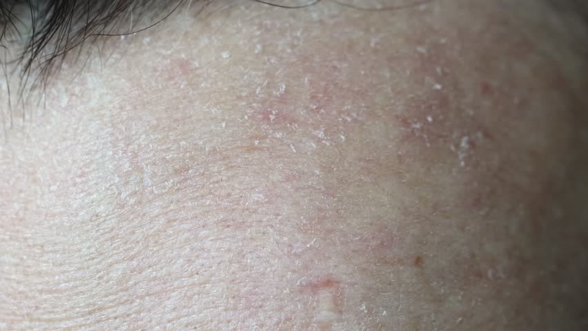 Dry skin of a woman's face close-up, allergy and redness, disease.