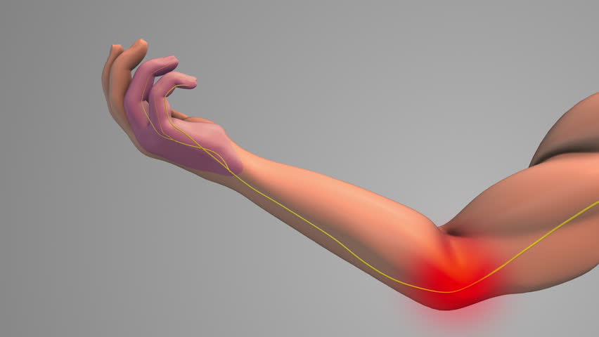 Cubital tunnel syndrome medical concept
