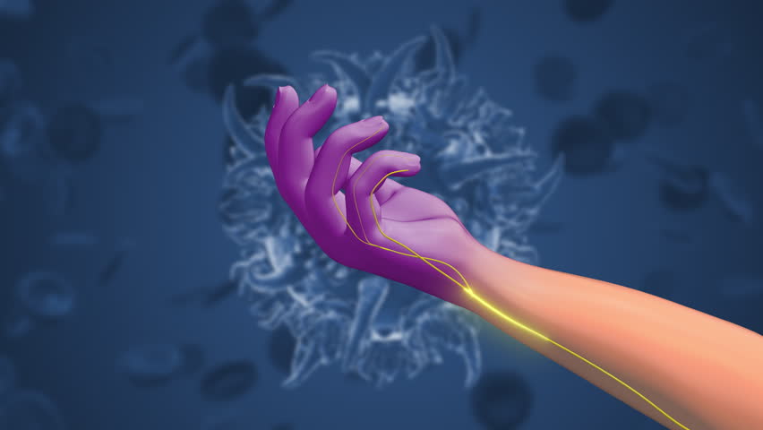 Effects of Guillain Barre Syndrome on Body Sensations