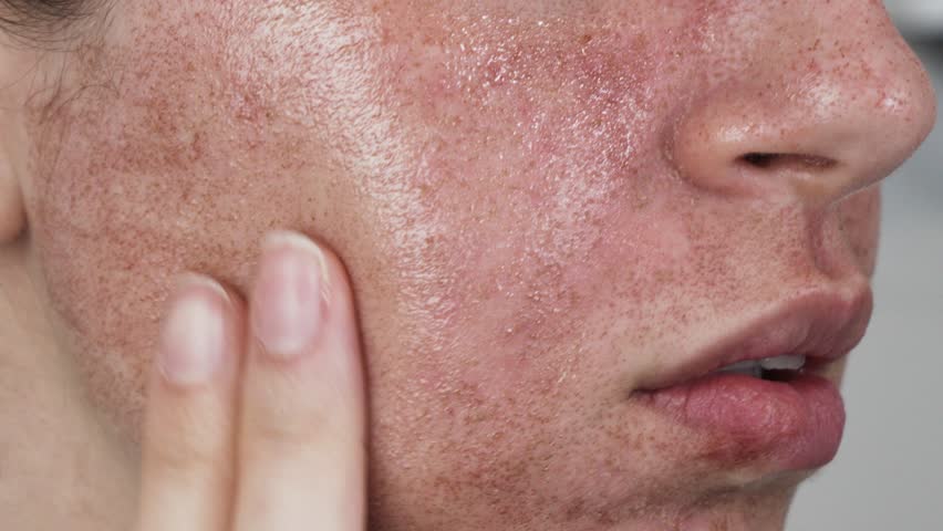 close up applying cream on burned from laser treatment face woman