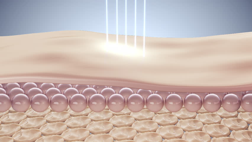 Laser shot through skin cell layer, skin and Facial treatment. 3D animation.