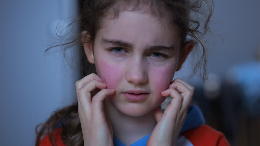 Girl Has Dry Red Skin and Scratching Her Face. Child Scratches Atopic Skin. Dermatitis, Diathesis, Allergy on Child Body and Face. Irritation and Pruritus. Kid Having Allergic Reaction on Skin to Food