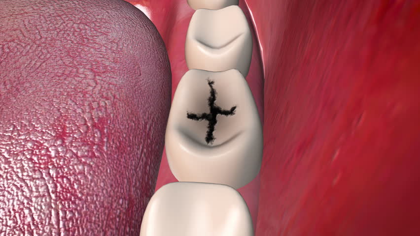Dental Caries Formation on Molar Tooth
