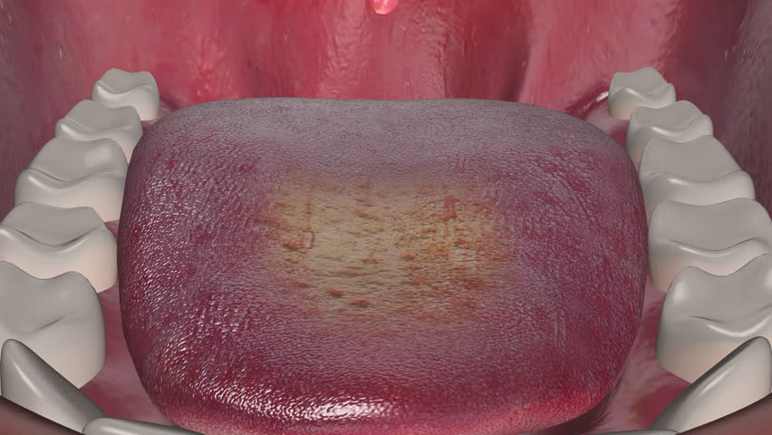 Oral thrush Fungal Infection on Tongue