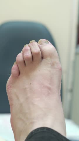  Professional Podiatry Callus Removal Procedure