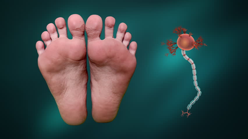 Loss of Sensation in Feet from Guillain Barre Syndrome