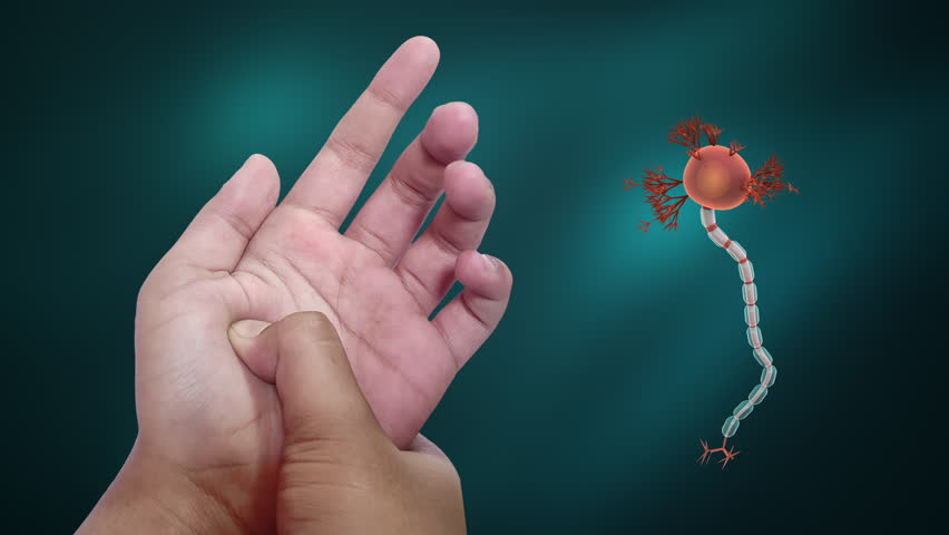 Hand Palm Sensation Loss Due to Guillain Barre Syndrome