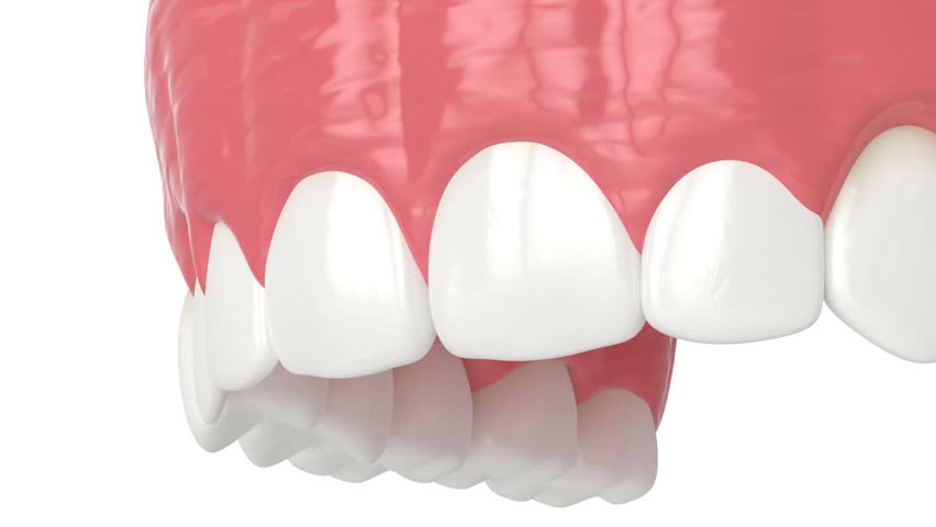 Upper jaw treated with laser for gummy smile. Creating a new gum line by gingivectomy.