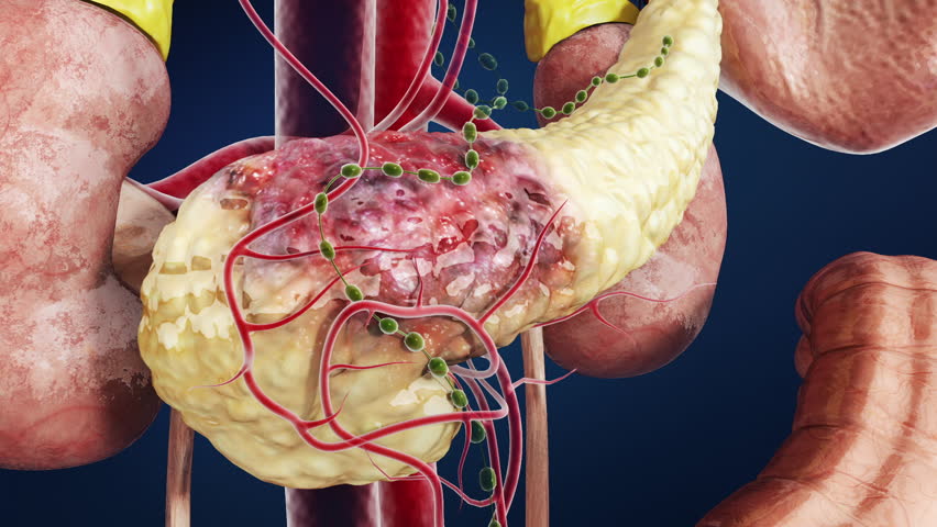 Pancreatic cancer or pancreatitis is cured, radiotherapy and chemotherapy treatment methods, the pancreas becomes healthy.3d animation.