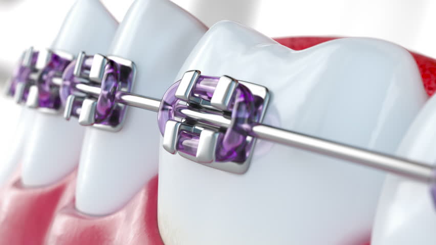 Close up of human teeth model with a dental braces, Orthodontic treatment and dental care. 3D Illustration