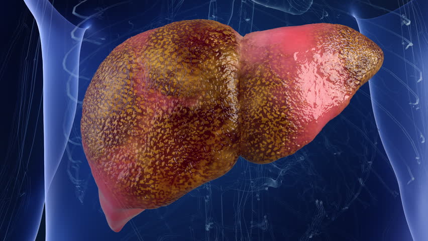 Liver disease spread throughout the liver, healthy liver with lesions as cirrhosis, hepatitis and liver damage, 3D animation.