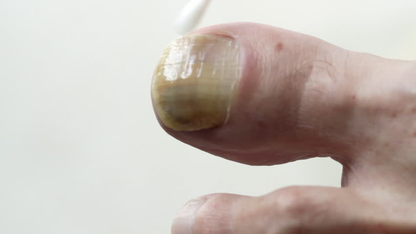 Treating a fungal infection on the toenail of a big toe. Shot with macro lens