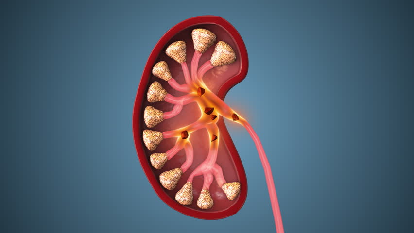 Mineral Buildup Leading to Kidney Stone Pain