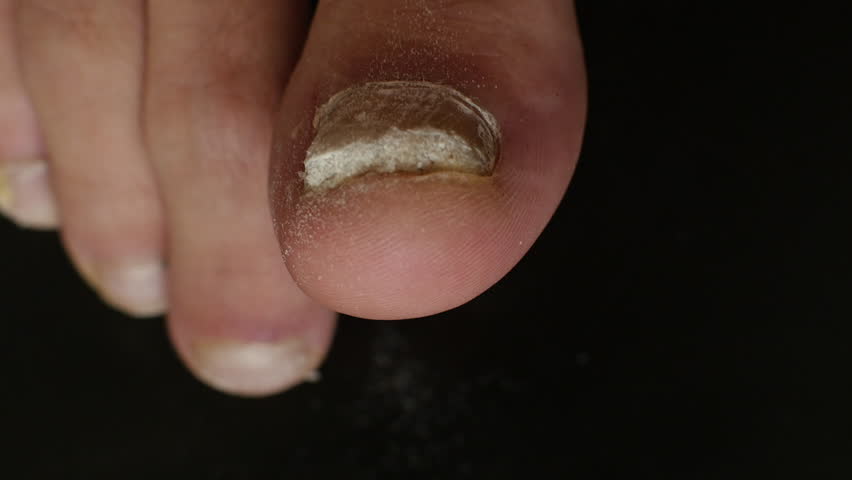 Close-up of a thick fungal toenail being filed on a black clinical background