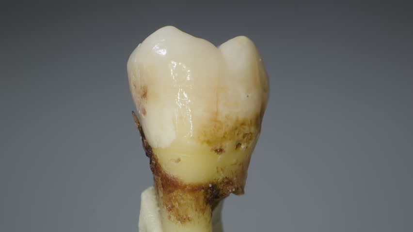 Extracted molar tooth from human adult male. Showing extreme decay, moderate wear and severe damage. Dental cavities, plaque and tartar. Probe lens macro. Extreme closeup. Looping clip.