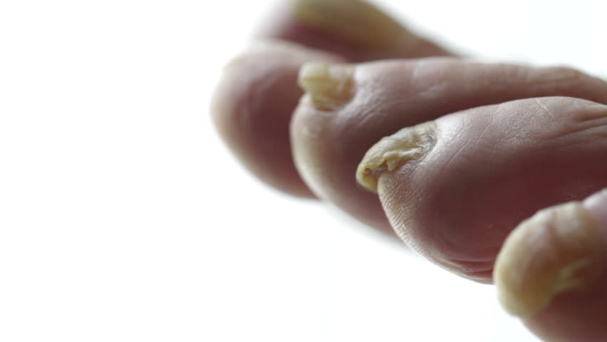 Treating a fungal infection on an infected toenail. Shot with macro lens and