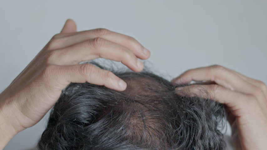 Baldness, hair loss , androgenic alopecia, dandruff. Man showing bald spot on his head.