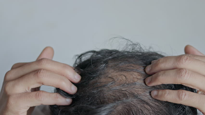 Baldness, hair loss , androgenic alopecia, dandruff. Man showing bald spot on his head.