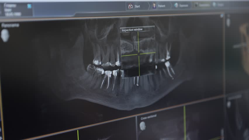 A dental X-ray showing a comprehensive image of the teeth and jaw structure in detail