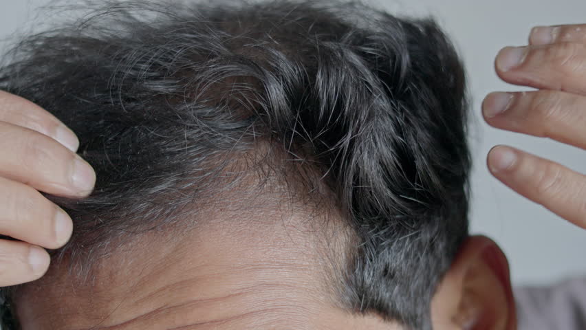 Hair loss, male pattern baldness, androgenic alopecia, hair thinning, dandruff. Man touching his bald patches.