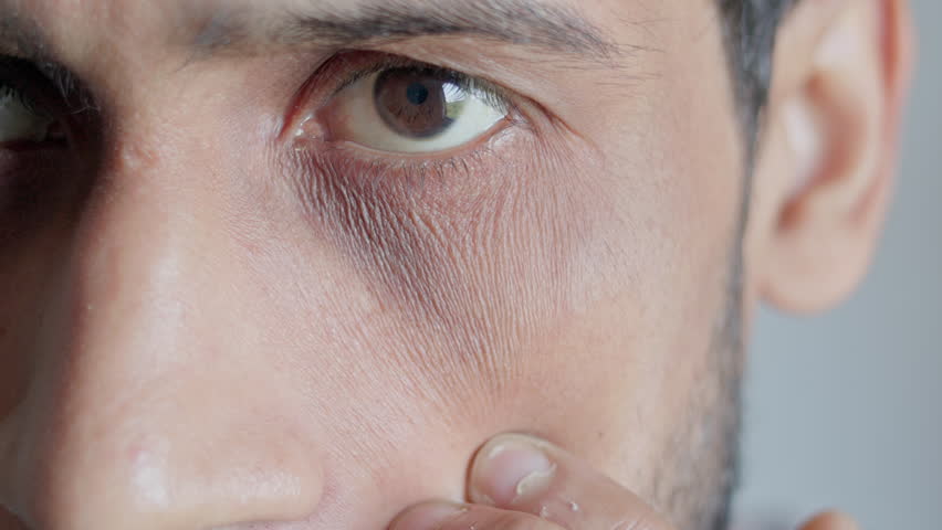 Indian young man showing his periorbital dark circles.