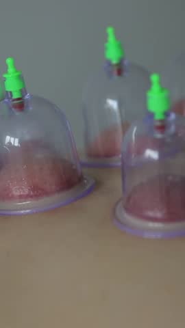 Multiple vacuum cups applied for medical cupping therapy on the human body, close-up view. Vertical video