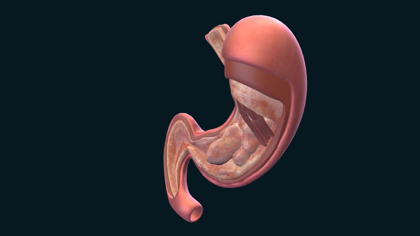 Stomach Cancer 3d Medical Illsutration, 3D Animation