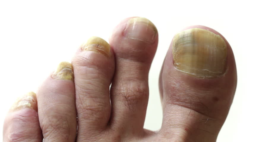 Toenails with common fungal infection. Shot with macro lens and shallow depth of
