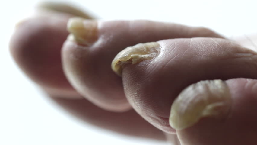 Detail of a fungal infection on a person's toenail. Shot with macro lens and