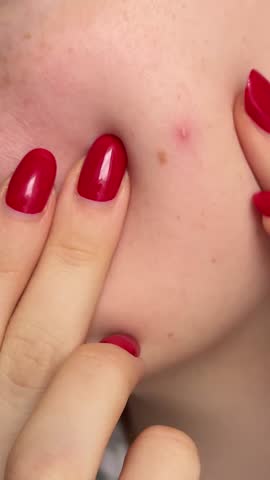 Close up photo of acne prone skin, young woman squeezing her pimple, Removing pimple from neck. Acne pus. squeezing pimple macro