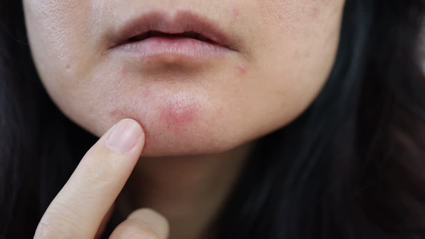 Problems face skin with acne and enlarged pores. Woman touching her face with a pimple.