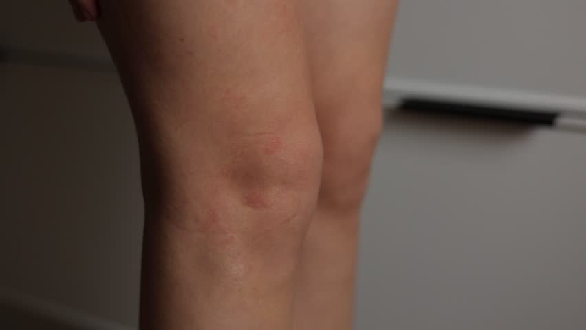 Allergic rash on leg itches. Woman strongly scratches her skin on knee with red rash caused by insect bites. Dermatitis, folliculitis, eczema, fungal infection. Affected area of skin to turn to swell