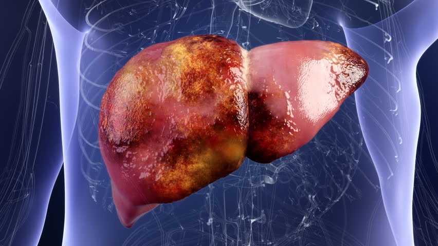 Liver cysts getting better, liver diseases being treated with medicines, liver cysts, cirrhosis, hepatitis and cancer etc. turning into healthy liver, digestive system treatment, 3D animation.4K.