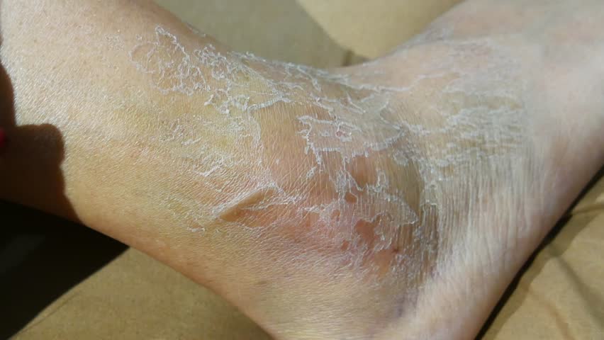 the skin of the feet peels off after swelling