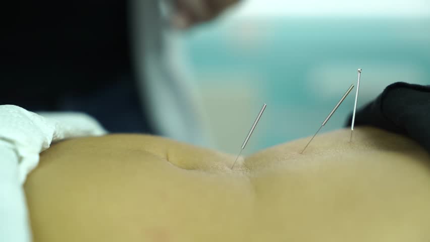 Abdominal acupuncture treatment for holistic healing 4K