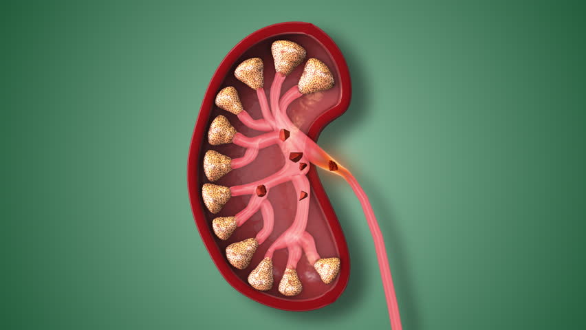 Kidney Stone Pain Triggering Urinary Tract Discomfort