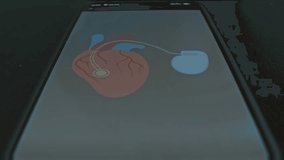 Implanted medical device Pacemaker presentation - Powered by Shutterstock - Get 15% off with code: PIKWIZARD15