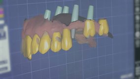 Dental CAD Software Designing Zirconia Crowns - Powered by Shutterstock - Get 15% off with code: PIKWIZARD15