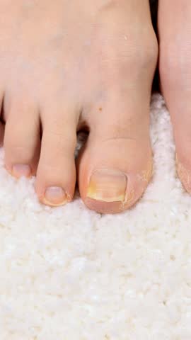 Vertical footage of a onycholysis on the toe. Detachment of the nail from the nail bed. Podiatry problems with thick toenails. Close up human finger on foot.