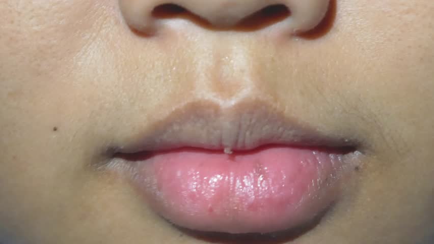 inflamed canker sores on the lips