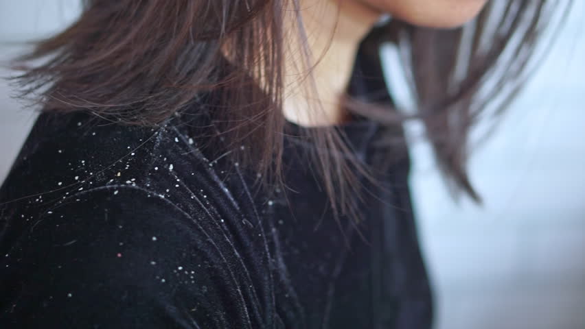 woman scratching itchy scalp, struggling with dandruff, white flakes on hair and shoulders, caused by dry, oily skin, skin irritation, hair products, or skin conditions like seborrheic dermatitis