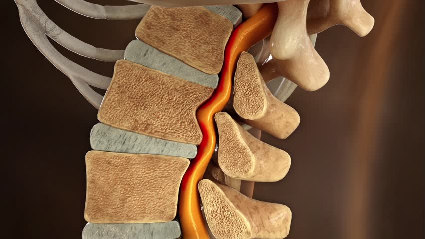 Treat compressed spinal nerves and restore lumbar disc herniation to a healthy state, 3d animation.