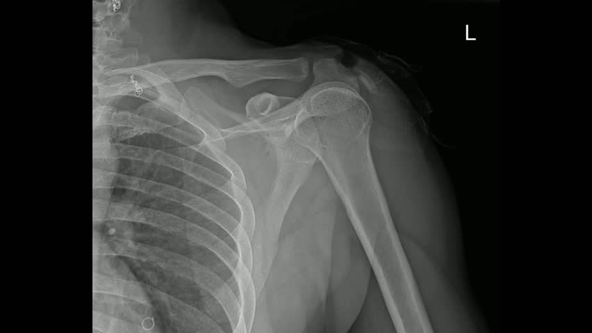  Shoulder AP X-Ray Showing Clavicle and Humeral Head Alignment