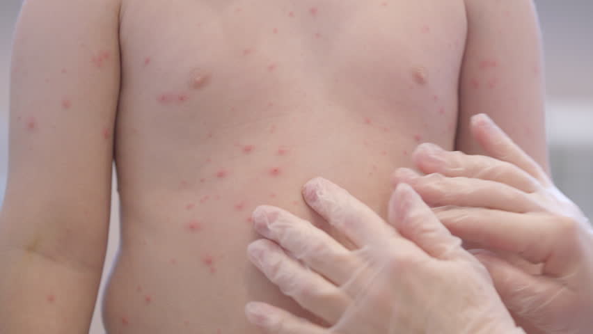 CloseUp Image of a Child Displaying Skin Rash chickenpox Symptoms for Consultation and Awareness
