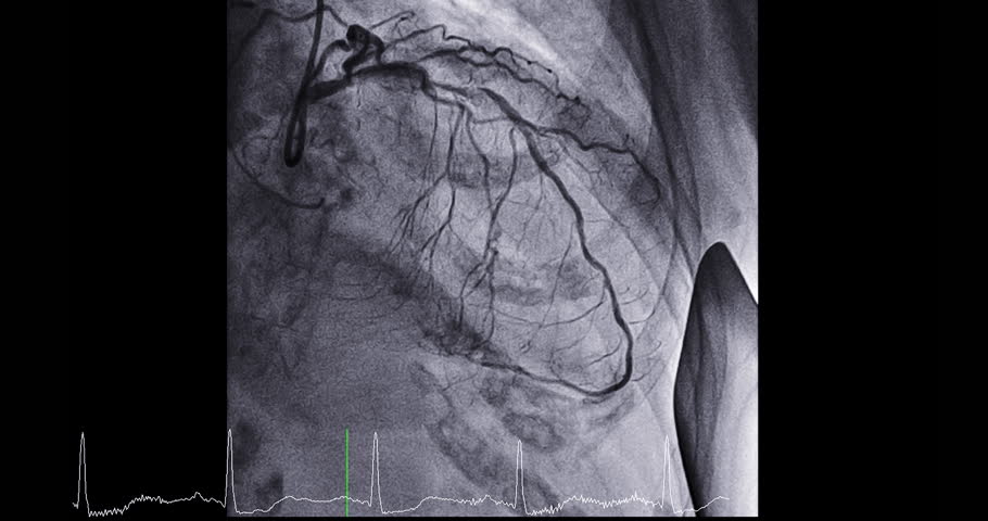 Cardiac catheterization showing coronary arteries Movies scene used to diagnose and treat some heart conditions.