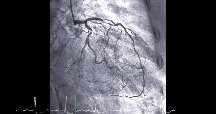 Cardiac catheterization showing coronary arteries Movies scene used to diagnose and treat some heart conditions.