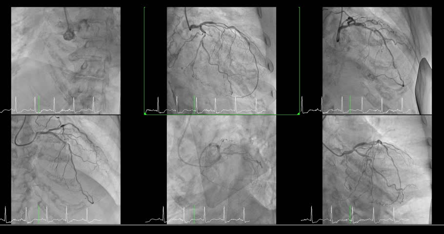 Cardiac catheterization showing coronary arteries Movies scene used to diagnose and treat some heart conditions.