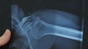 Close-Up of Shoulder X-Ray Examination - Powered by Shutterstock - Get 15% off with code: PIKWIZARD15