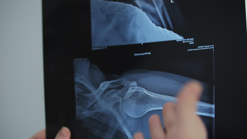 Doctor Analyzing X-Ray of Shoulder Joint