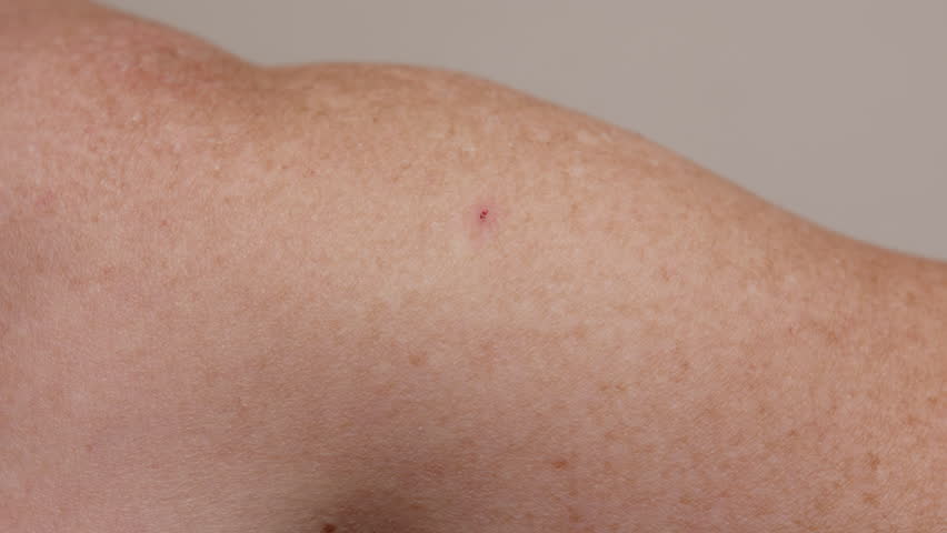 Sores and wounds on body after skin damage due to sunburn during tanning close-up.